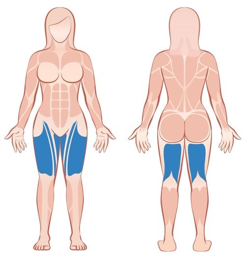 Darstellung der oberen Beinmuskulatur in dunkelblau an einer weiblichen Person.